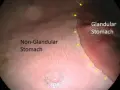 Gastroscopie cheval : vue endoscopique du cardia, marquant la limite entre l'estomac glandulaire et non glandulaire.