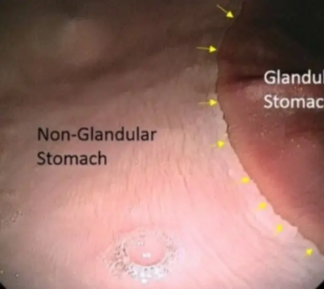 Gastroscopie cheval : vue endoscopique du cardia, marquant la limite entre l'estomac glandulaire et non glandulaire.